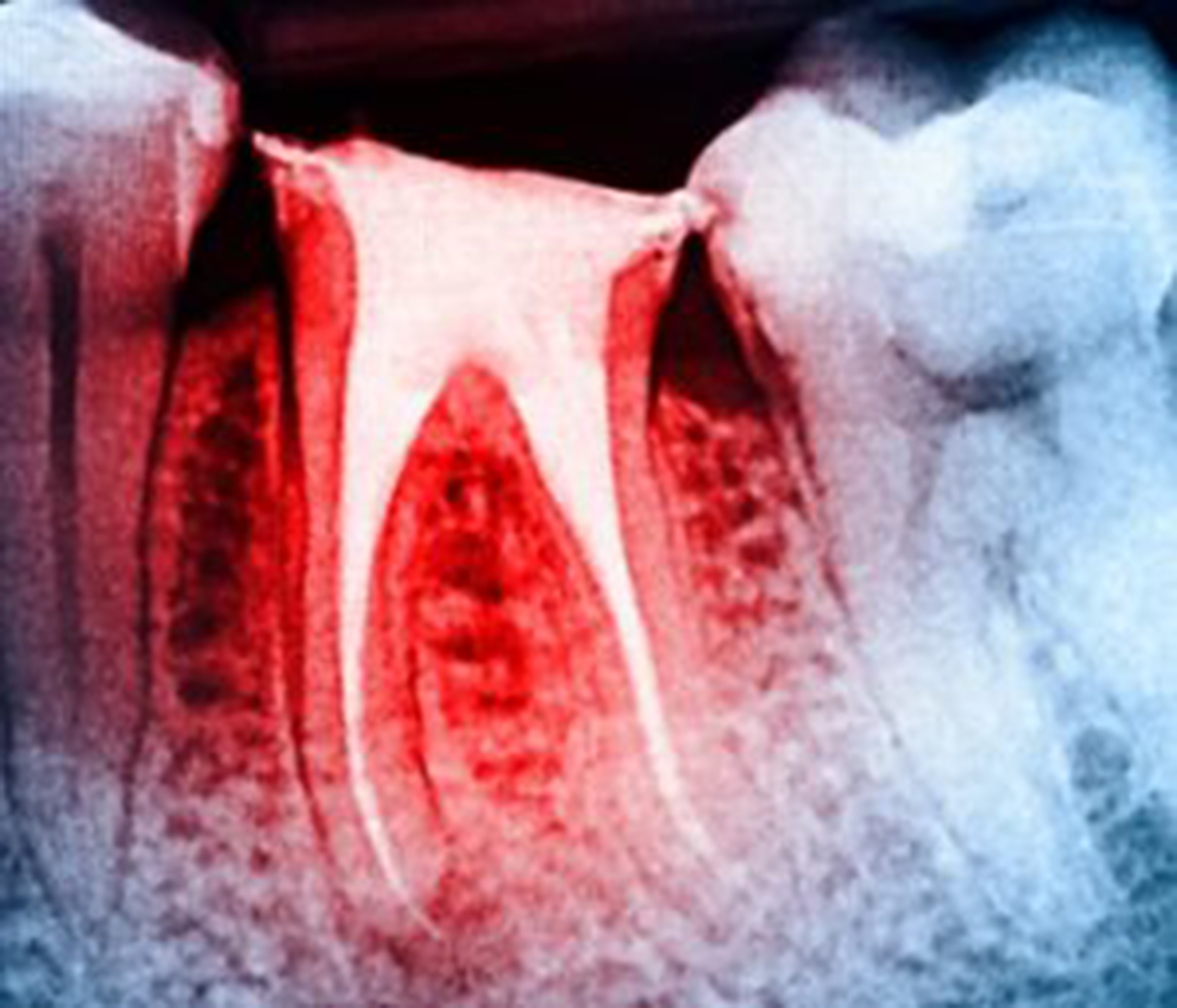 root canal treatment san francisco ca, root canal x-ray