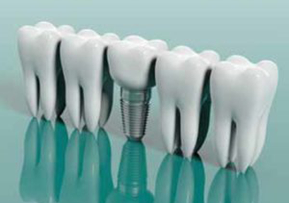Process of Dental implants in San Francisco CA Area
