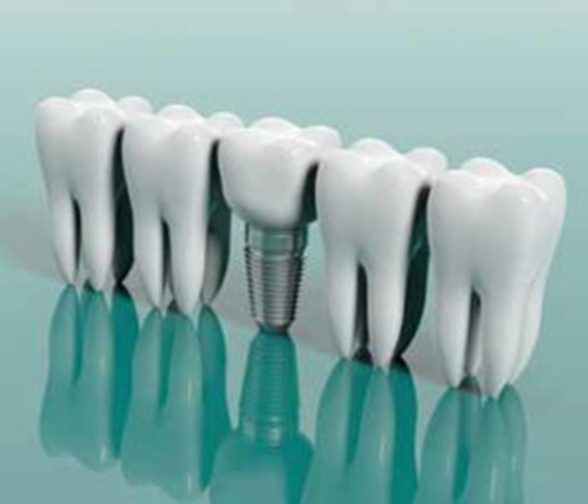 At West Portal Family Dentistry, team of professionals provide restorative dentistry solutions such as dental implants to provide patients in and around San Francisco, CA