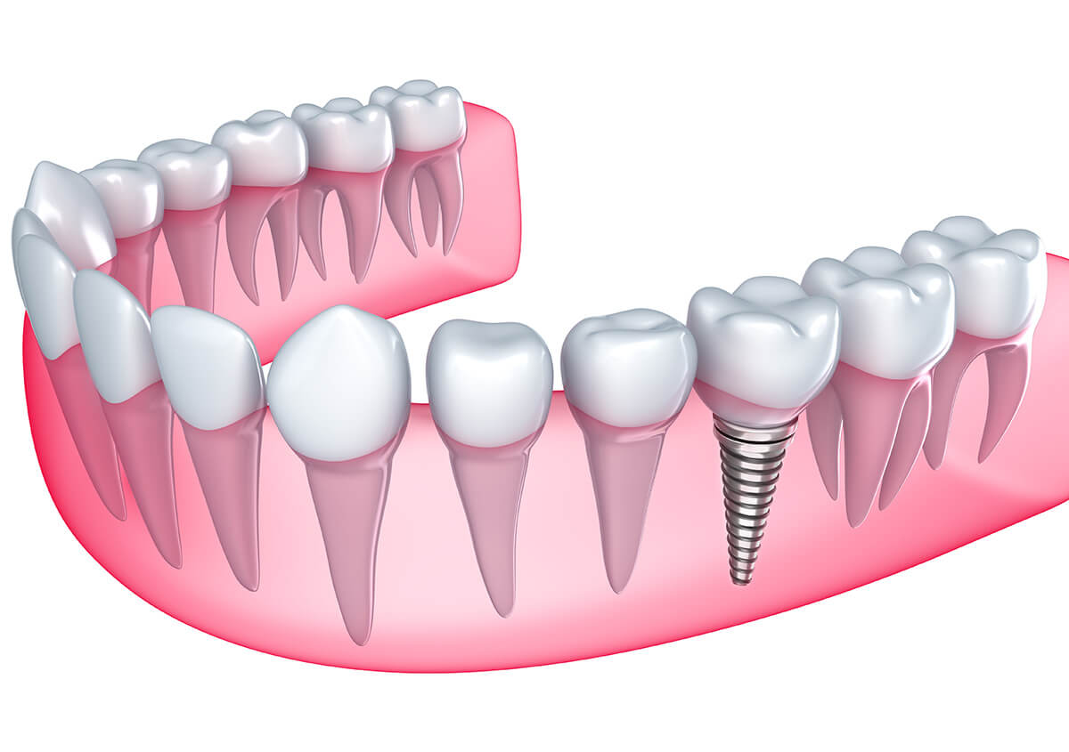 Dentist Explain About Teeth Implant in San Francisco Area