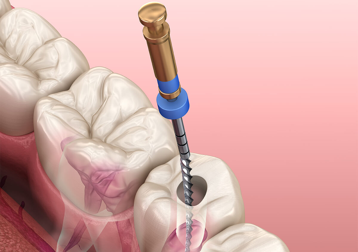 Painless Root Canal Treatment Near Me San Francisco CA Area